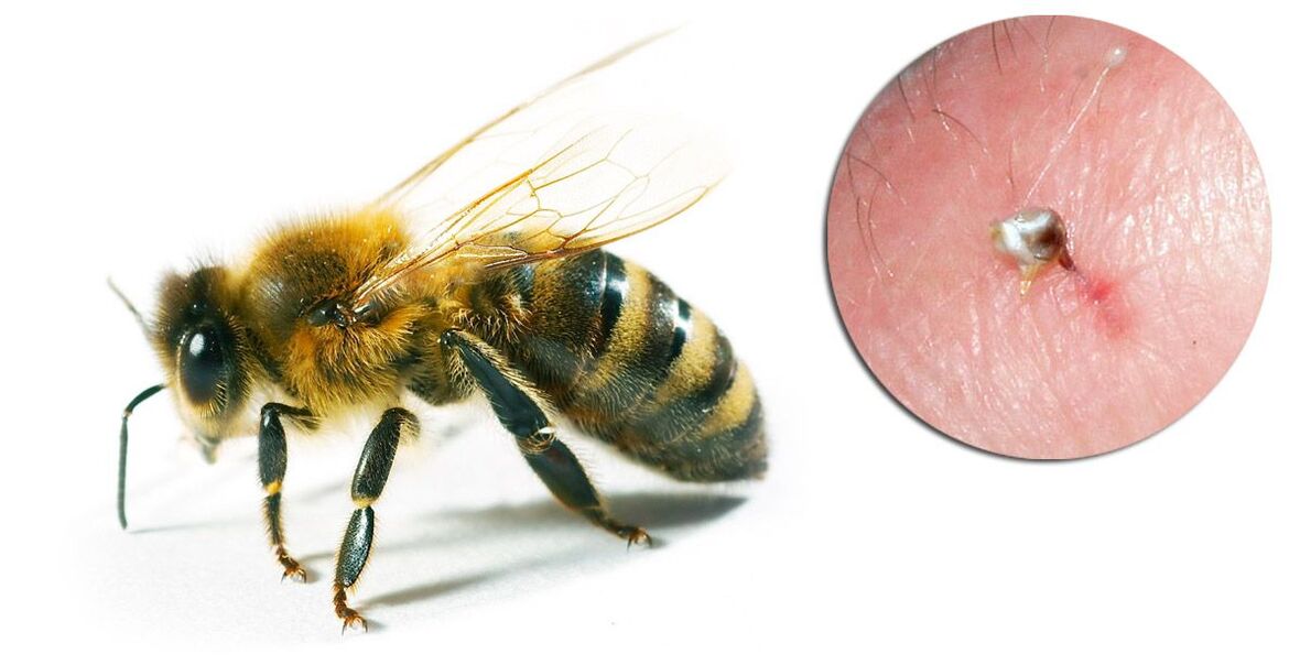 Hondrostrong contén veleno de abella, que mellora os procesos metabólicos nos tecidos