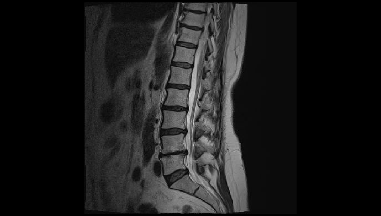 Diagnosticar a dor nas costas na rexión lumbar