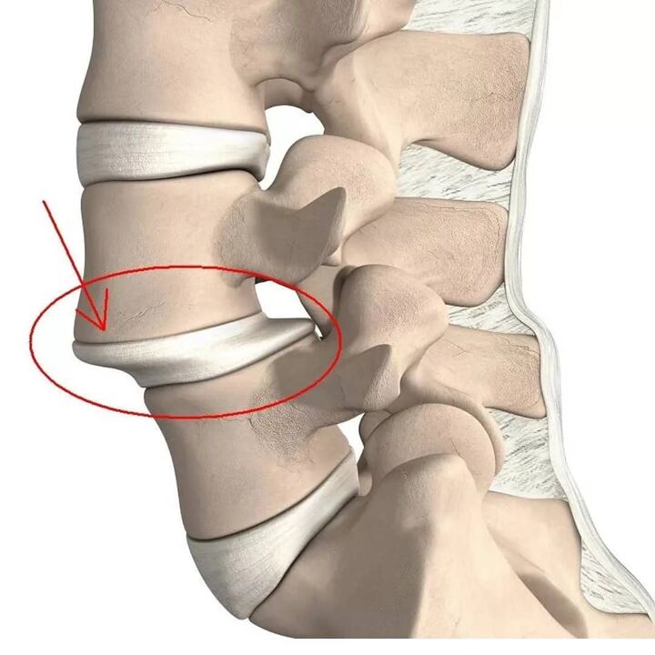 Lesións vertebrais