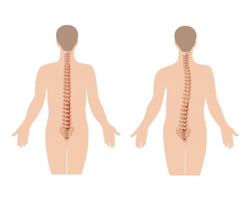 columna vertebral san e enferma