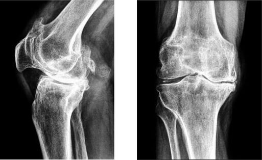 Radiografía de gonartrose do xeonllo