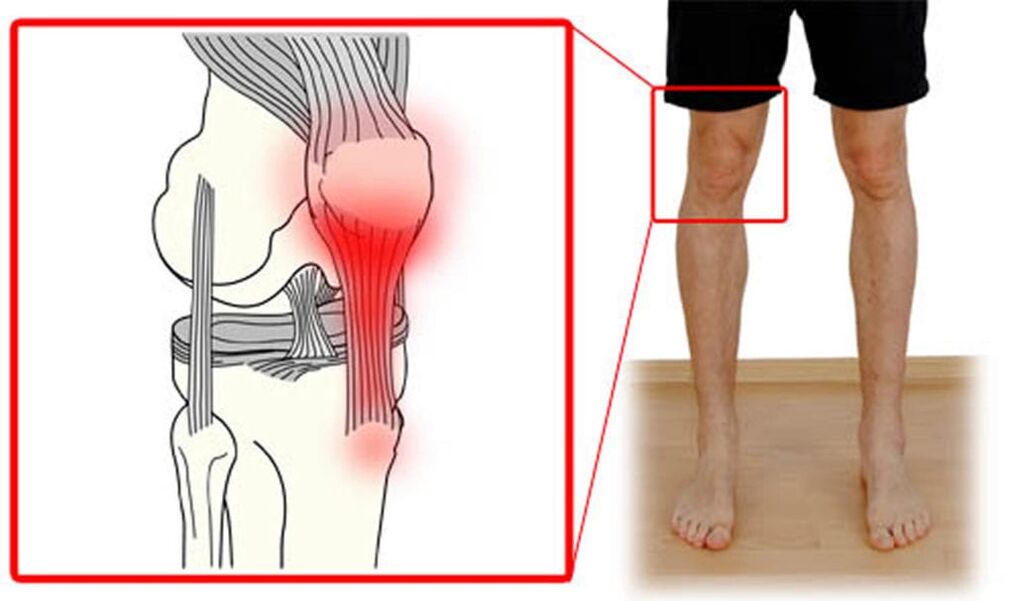 Tendinite - inflamación dos tendóns na articulación do xeonllo