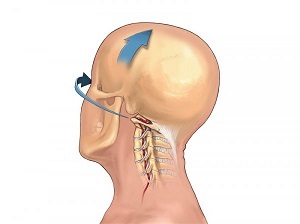 como se manifesta a osteocondrose da columna cervical