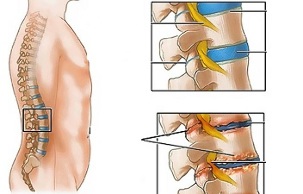 Causas de osteocondrose da columna lumbar