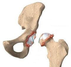 Causas da artrose na articulación da cadeira