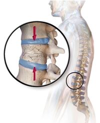 A osteoporose provoca dores nas costas na zona lumbar